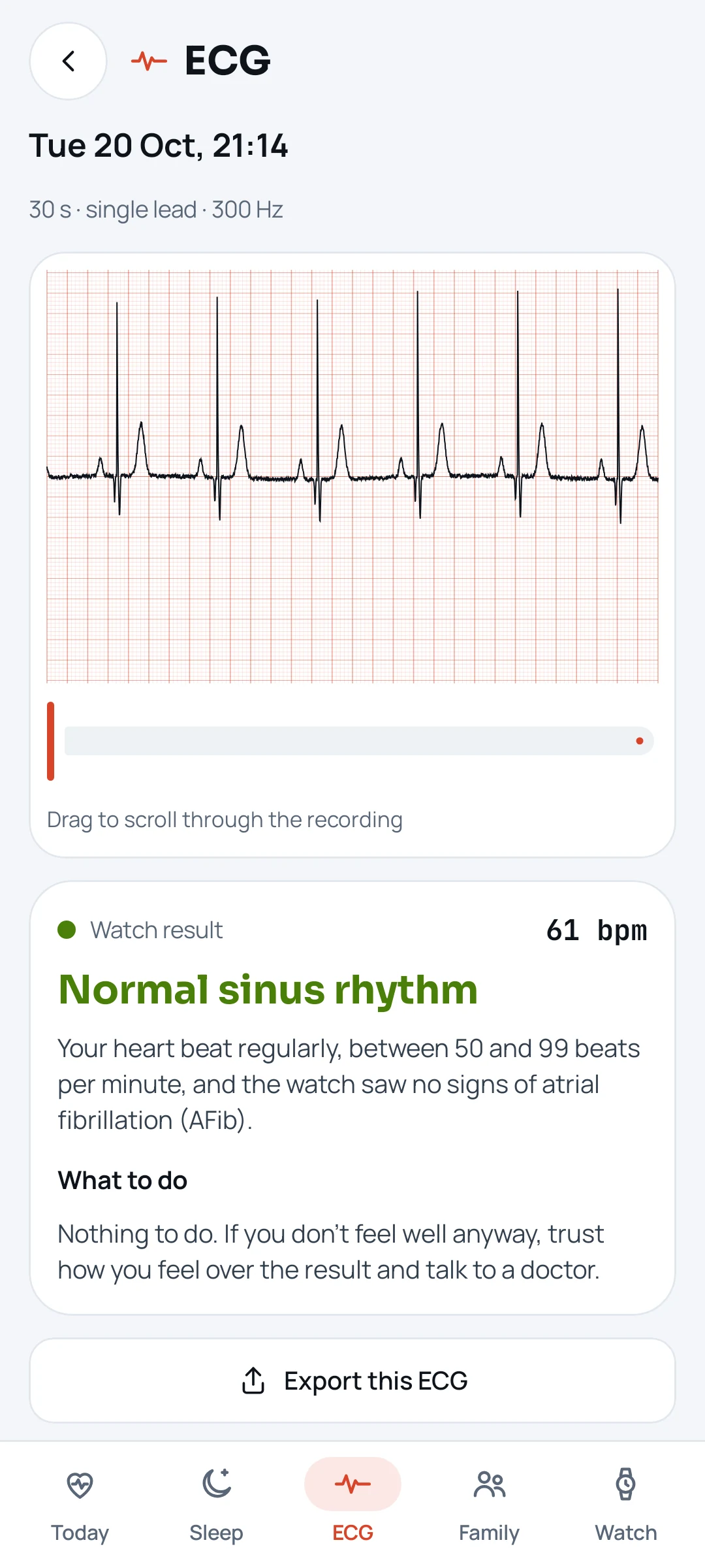 The app's ECG screen: a recording with its classification.